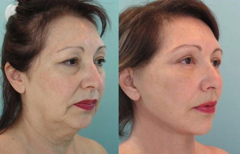 El resultado del rejuvenecimiento de la piel del rostro reafirmante con hilos. 
