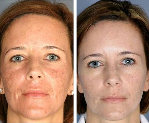 Antes y después de la termólisis facial fraccionada. 