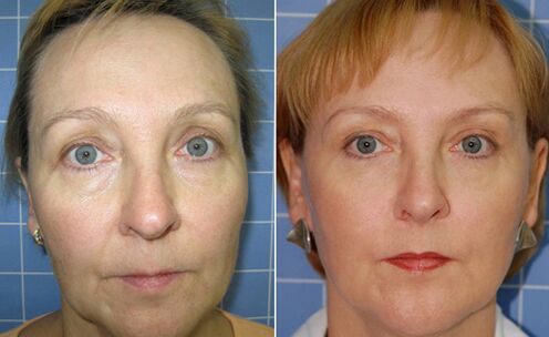 Antes y después del lifting facial con láser fraccionado