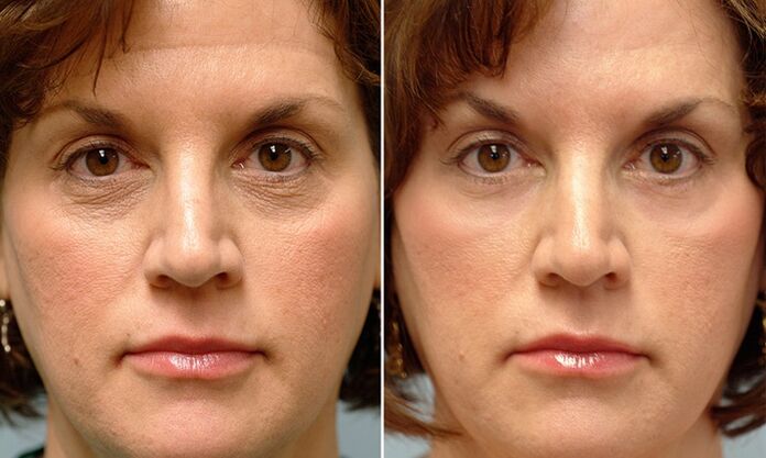rostro antes y después del rejuvenecimiento fraccional con láser