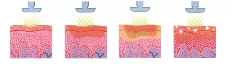 cómo funciona un sistema de rejuvenecimiento en la piel
